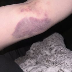 BioLife Plasma Services - My arm 5 days later still in pain