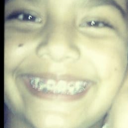 My daughter in her first weeks of ortho she loves her braces
