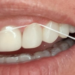 Steven P Marsh, DDS - Floss behind the bonding!