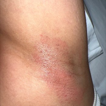 Renu Beauty Salon - Underarm wax aftermath. - Threading Services Near Me - Yonkers, New York Renu Beauty Salon - Underarm wax aftermath. - Threading Services Near Me - Yonkers, New York