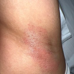 Renu Beauty Salon - Underarm wax aftermath.