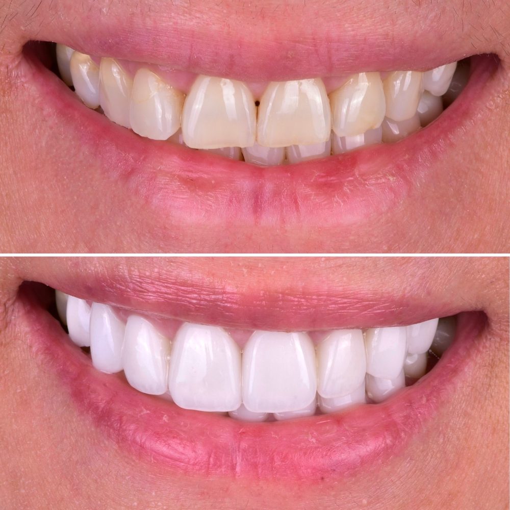 Cosmetic Veneers Cedarhurst, NY