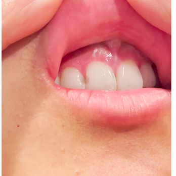 StoneCreek Dental Care - Hoover - Previous clinic told me they couldn't match my filling any more than this shade. - Cosmetic Dentists Near Me - Hoover, Alabama StoneCreek Dental Care - Hoover - Previous clinic told me they couldn't match my filling any more than this shade. - Cosmetic Dentists Near Me - Hoover, Alabama