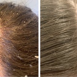 Dandruff removal