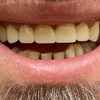 Avid Dental - After - General Dentistry Near Me - Mount Prospect, Illinois Avid Dental - After - General Dentistry Near Me - Mount Prospect, Illinois