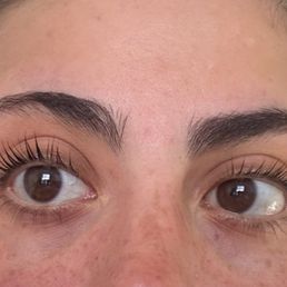 After less noticeable acne  scars