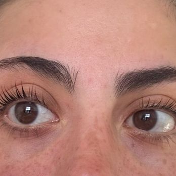 Matahari Skin Solutions - After less noticeable acne  scars - Skin Care Near Me - San Francisco, California