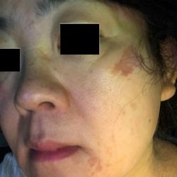 Ceja Por Asiya - Taken two days after waxing at Threading by Asiya -- visible burns and no accountability from the business. Be cautious.
