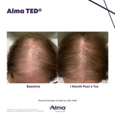 Alma TED - Alma TED is a non invasive, FDA approved treatment that is clinically proven to regrow hair. There is no pain, no needles, and no downtime with treatment. A minimum of 3 sessions spaced 4 weeks apart required to see results. Some patients may need or want additional treatments after initial series. Schedule a complimentary consultation to learn more today! Alma TED - Alma TED is a non invasive, FDA approved treatment that is clinically proven to regrow hair. There is no pain, no needles, and no downtime with treatment. A minimum of 3 sessions spaced 4 weeks apart required to see results. Some patients may need or want additional treatments after initial series. Schedule a complimentary consultation to learn more today!