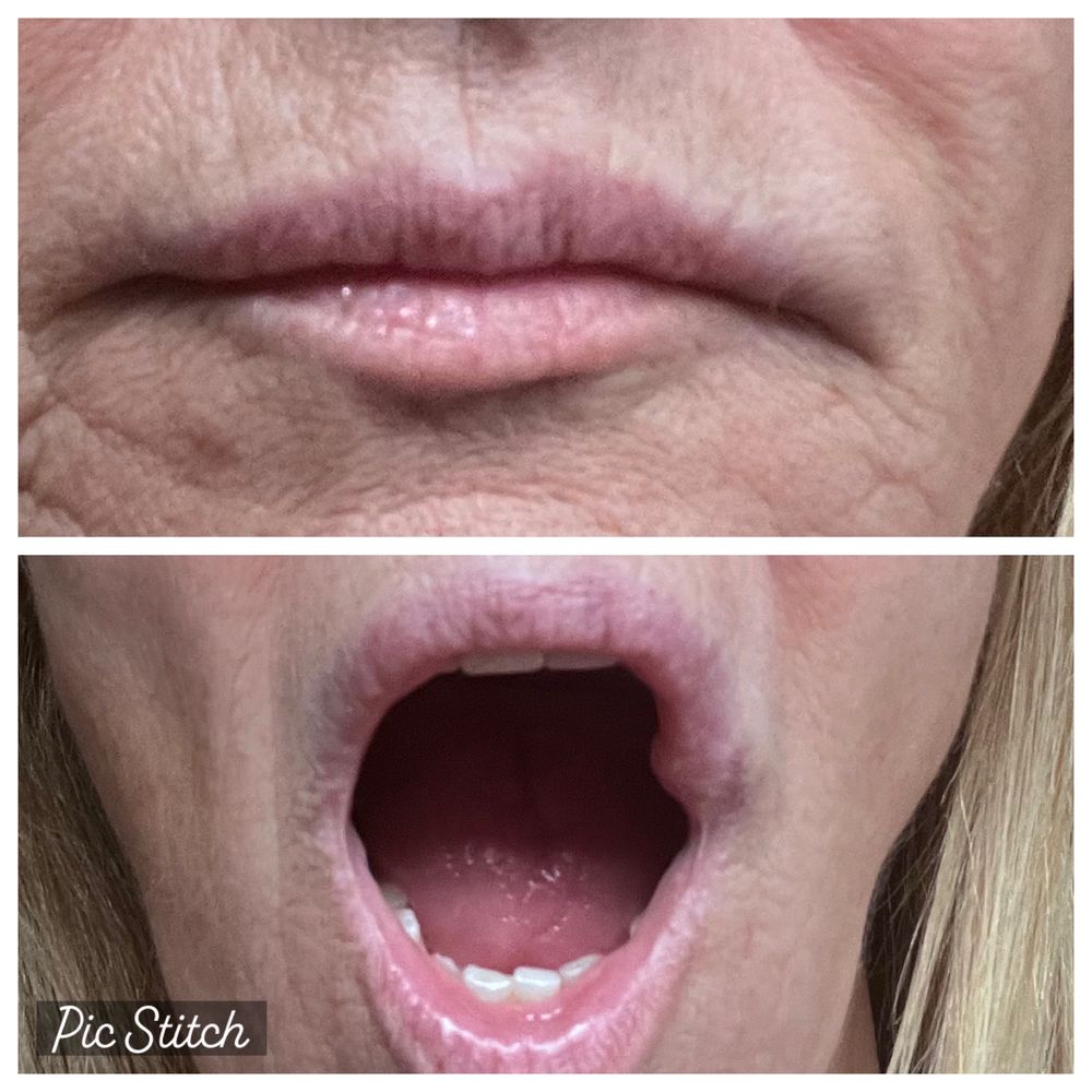 Injected filler to the area outside my lips stating it would decrease the frown. Injected filler to the area outside my lips stating it would decrease the frown.