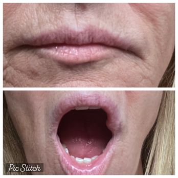 Luna Vision and Med Spa - Injected filler to the area outside my lips stating it would decrease the frown. - Laser Eye Surgery/Lasik Near Me - Tarentum, Pennsylvania Luna Vision and Med Spa - Injected filler to the area outside my lips stating it would decrease the frown. - Laser Eye Surgery/Lasik Near Me - Tarentum, Pennsylvania