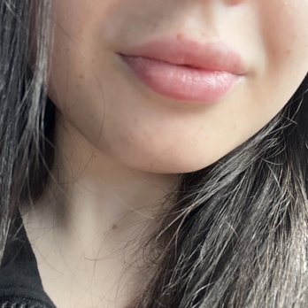 LaserAway - Right after the second appointment - Laser Hair Removal Near Me - Newport Beach, California