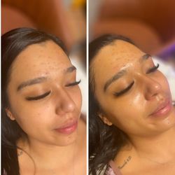 Renew Med Spa & Cryotherapy - Before and After Hydrafacial!