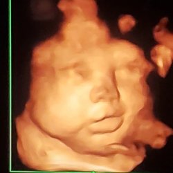 InVision 3D4D Ultrasound