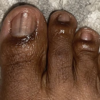 Varnish Lab - Diseased and deformed nail bed. - Nail Salons Near Me - Playa Vista, California Varnish Lab - Diseased and deformed nail bed. - Nail Salons Near Me - Playa Vista, California