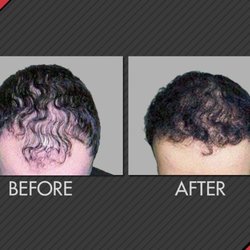 MAXiM Hair Restoration