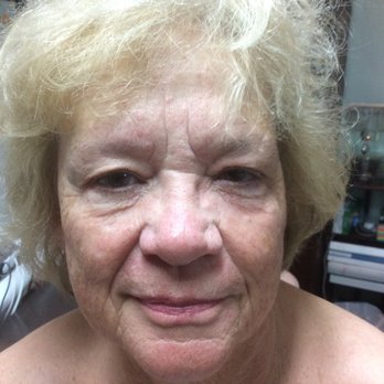 R5 Skinworks - After - Skin Care Near Me - Clearwater, Florida R5 Skinworks - After - Skin Care Near Me - Clearwater, Florida