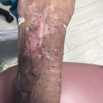 Pegah Samouhi, DPM - After picture of healed wound - Podiatrists Near Me - Los Angeles, California Pegah Samouhi, DPM - After picture of healed wound - Podiatrists Near Me - Los Angeles, California
