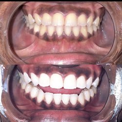 60 Minute Teeth Whitening Session