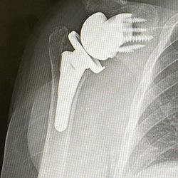 John M Itamura, MD - Kerlan Jobe Orthopaedic Group - The work of Dr . John Itramura Adventist White Memorial Kerlan jobe orthopedic Reverse Total Shoulder joint replacement