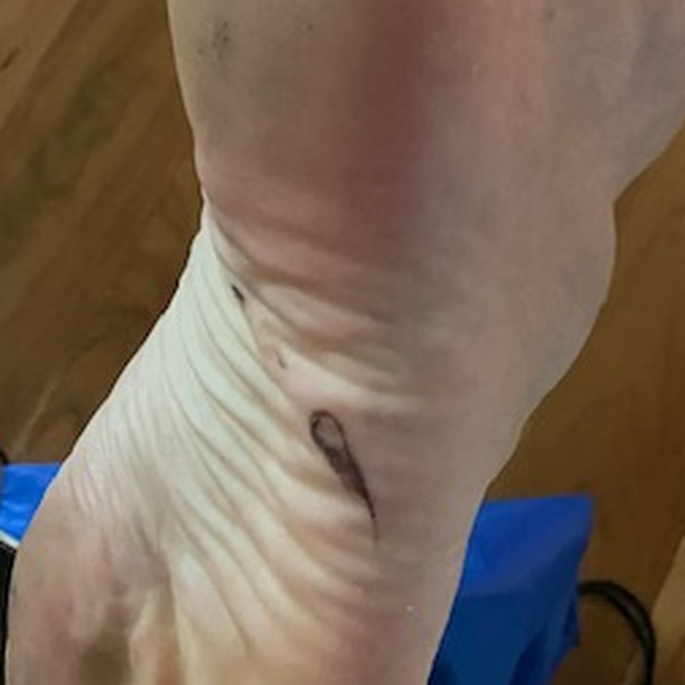 Got a screw in the foot walking to the bathroom at night! Got a screw in the foot walking to the bathroom at night!