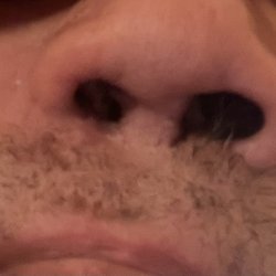 Oren Friedman, MD - Blocked and reduced nostril after surgery.
