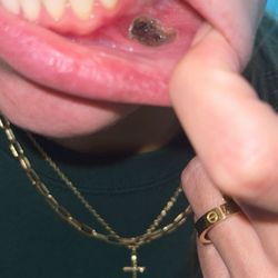 Integrity Dental - the burned hole in my gums during