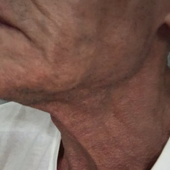 Paul Wigoda, MD - Some of the stages of damage over 2 months. - Cosmetic Surgeons Near Me - Fort Lauderdale, Florida Paul Wigoda, MD - Some of the stages of damage over 2 months. - Cosmetic Surgeons Near Me - Fort Lauderdale, Florida