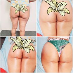 D’Luxe Silhouettes - Butt Enhancement Therapy Before and After