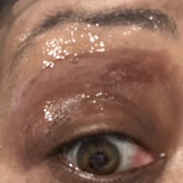 Huge scar/ bruise under my eyebrows after waxing.... There was no hair where the bruise is. Huge scar/ bruise under my eyebrows after waxing.... There was no hair where the bruise is.
