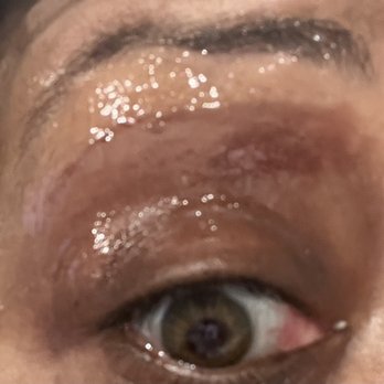 Nails Elite - Huge scar/ bruise under my eyebrows after waxing.... There was no hair where the bruise is. - Nail Salons Near Me - Hazel Park, Michigan Nails Elite - Huge scar/ bruise under my eyebrows after waxing.... There was no hair where the bruise is. - Nail Salons Near Me - Hazel Park, Michigan