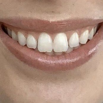 Usha Rajagopal, MD - Before Upper lip Botox - gummy smile - Cosmetic Surgeons Near Me - San Francisco, California