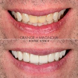 Orange and Magnolia Dental Studio - 10 porcelain veneers smile makeover by Dr. Joyce Kahng, cosmetic dentist in Orange County veneers