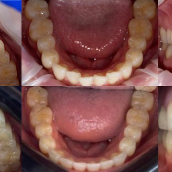 Impress - Before/After! - Orthodontists Near Me - San Francisco, California