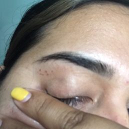 More scabs on the right eye. This one was worse More scabs on the right eye. This one was worse