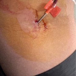 BioLife Plasma Services - Look at how the needle is slanted into my arm..