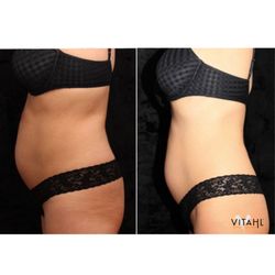 Vitahl Medical Aesthetics - Before (left) and after (right) of trusculpt iD. 24% fat reduction per treament with this no downtime, non-invasive body contouring!