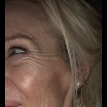 Laser MD MedSpa - This was their " Botox" work after 2 weeks. I went back thinking they would refill since it looks like water was injected. Kristi said No. - Medical Spas Near Me - Braintree, Massachusetts Laser MD MedSpa - This was their " Botox" work after 2 weeks. I went back thinking they would refill since it looks like water was injected. Kristi said No. - Medical Spas Near Me - Braintree, Massachusetts