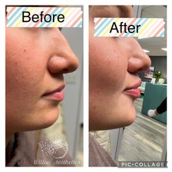 Lip filler