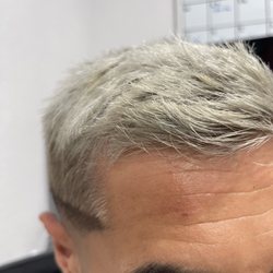 Fashion Hair Design - Forehead burn
