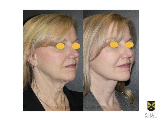 Shah Aesthetic Surgery - Rhinoplasty and Facelift Specialist by null