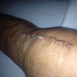 Accelerated Physical Therapy - Original knee replacement