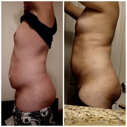 MIA Aesthetics Tampa - (1st photo) 13 days before (2nd photo) 13 days after surgery "round 2"