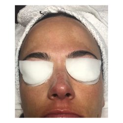 Skin Studio AZ - Pregnancy melasma