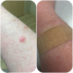 Davila Manuel MD - Before and after my biopsy. Dr. Davila was very gentle. I barely felt a thing!