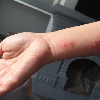 Best Western Inn - Bed Bug Bites my wife got staying at the Best Western in Merced. We complained and they told us there was no problem. - Hotels Near Me - Merced, California Best Western Inn - Bed Bug Bites my wife got staying at the Best Western in Merced. We complained and they told us there was no problem. - Hotels Near Me - Merced, California