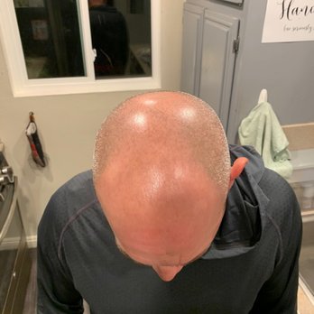Skalp Los Angeles - Before SKALP - Hair Loss Centers Near Me - Westminster, California