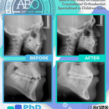 PhD Orthodontics - ABO Board Standard Finishing. Skeletal Changes - Orthodontists Near Me - San Gabriel, California PhD Orthodontics - ABO Board Standard Finishing. Skeletal Changes - Orthodontists Near Me - San Gabriel, California