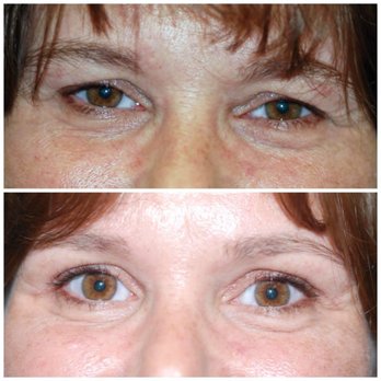 Steven Covici, MD, FACS - Before and After Results from Steven Covici, MD, FACS | Springfield, MA - Cosmetic Surgeons Near Me - Springfield, Massachusetts Steven Covici, MD, FACS - Before and After Results from Steven Covici, MD, FACS | Springfield, MA - Cosmetic Surgeons Near Me - Springfield, Massachusetts