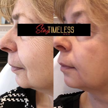 Stay Timeless On The Go - Dermal filler and Botox treatment - Medical Spas Near Me Stay Timeless On The Go - Dermal filler and Botox treatment - Medical Spas Near Me